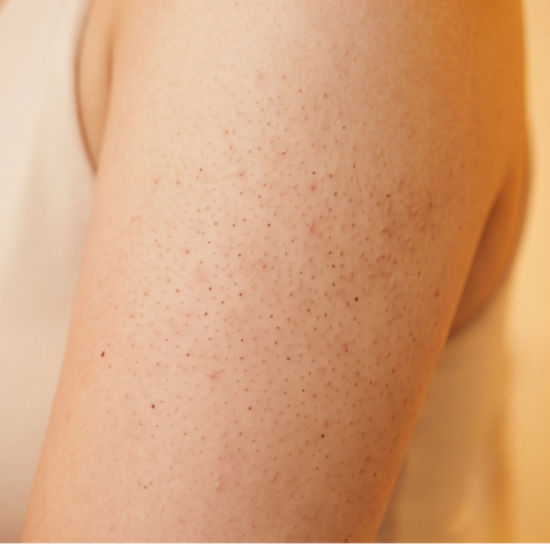 Strawberry skin texture